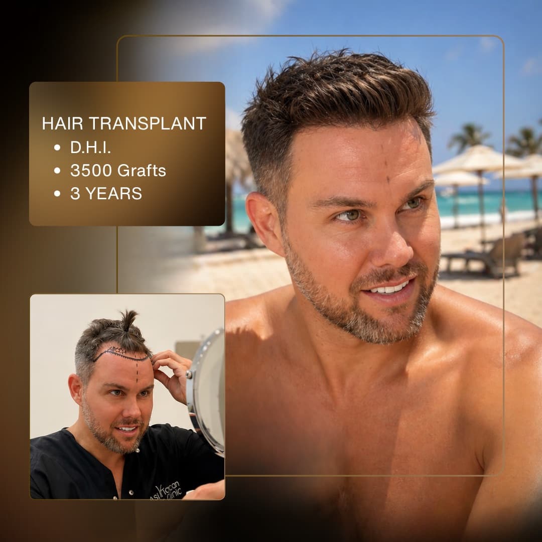 Before & After - D.H.I. 3,500 Grafts