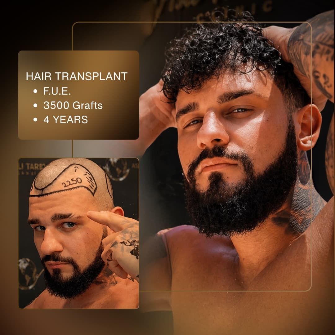 Before & After - F.U.E. 3,500 Grafts