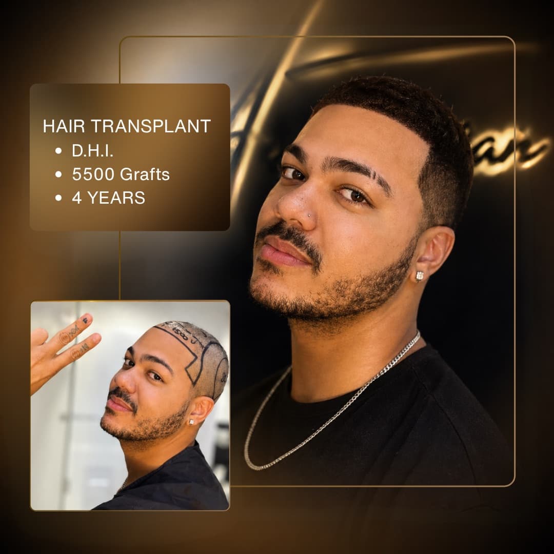 Before & After - D.H.I. 5,500 Grafts