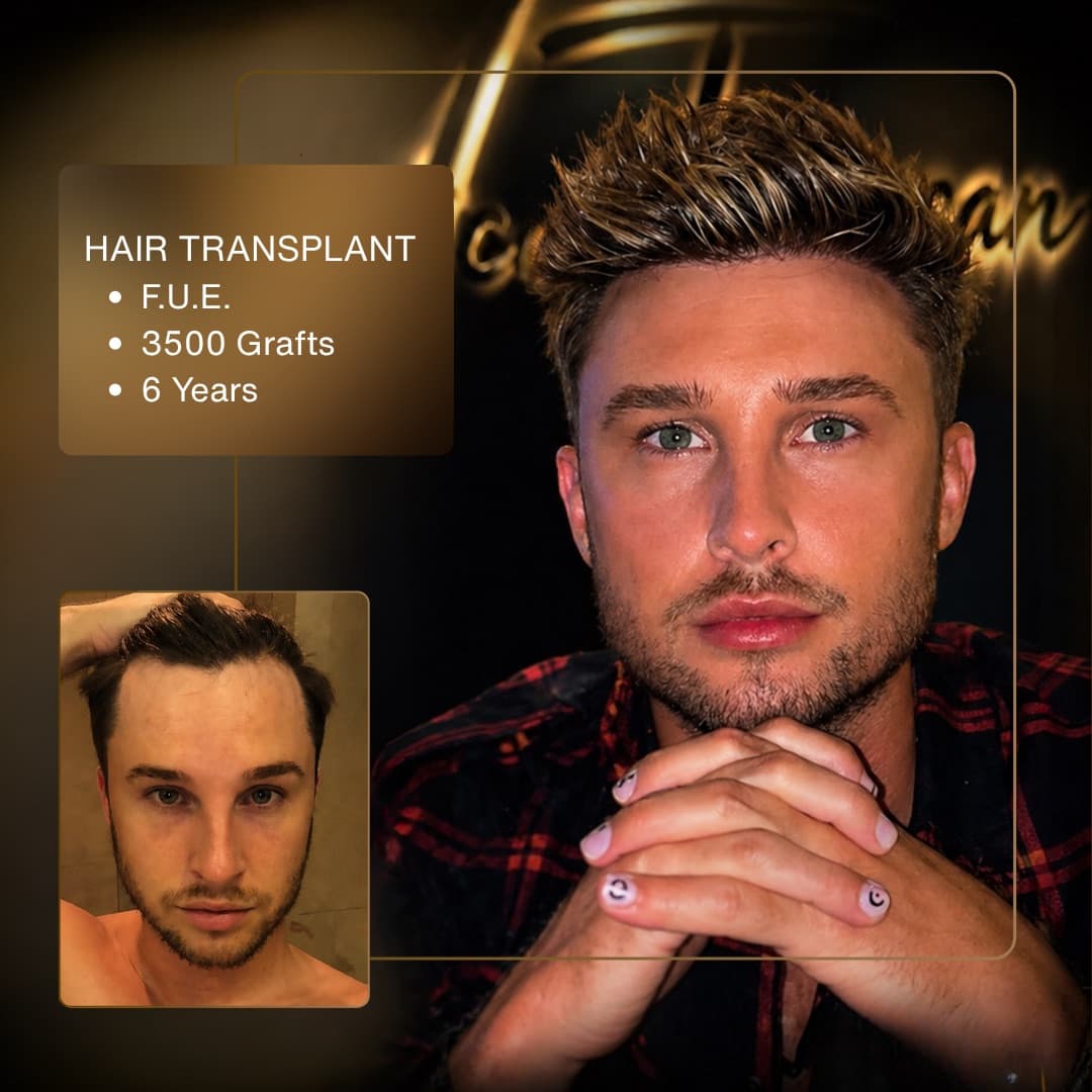Before & After - F.U.E. 3,500 Grafts