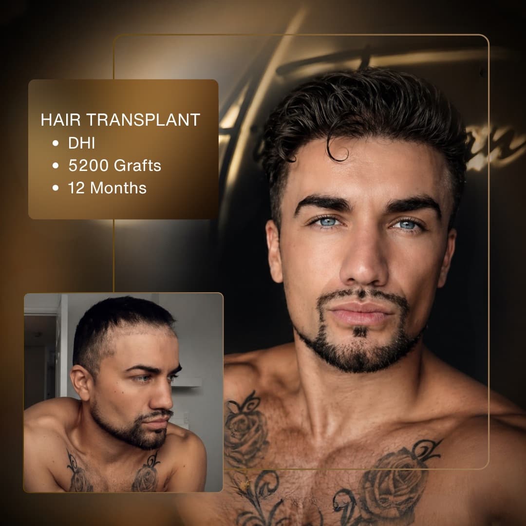 Before & After - DHI 5,200 Grafts