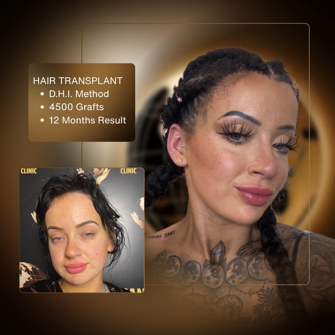 Before & After - D.H.I. 4,500 Grafts