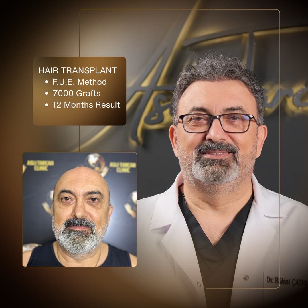 Hair Transplant Result